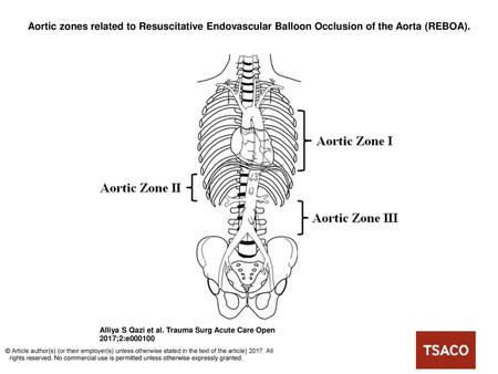 Aortic zones related to Resuscitative Endovascular Balloon Occlusion of the Aorta (REBOA). Aortic zones related to Resuscitative Endovascular Balloon Occlusion.