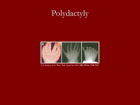 Polydactyly L.A. Lettice, et al. Proc. Natl. Acad. Sci. USA 2002; 99(11): 7548-7553.