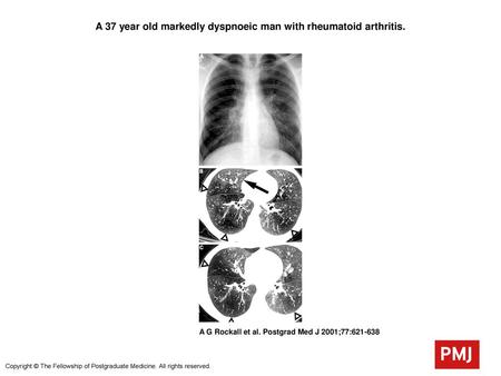 A 37 year old markedly dyspnoeic man with rheumatoid arthritis.