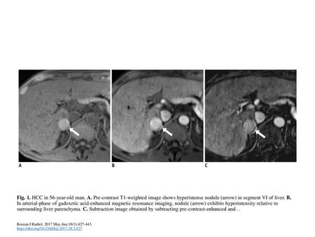 Fig. 1. HCC in 56-year-old man. A