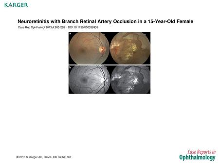 Case Rep Ophthalmol 2013;4: DOI: /