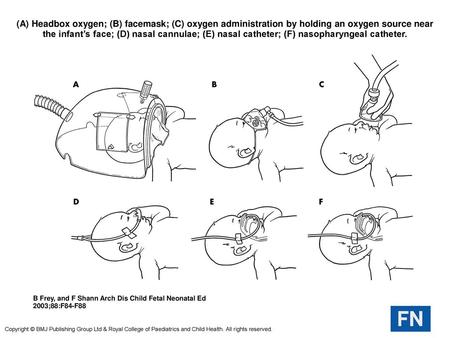 (A) Headbox oxygen; (B) facemask; (C) oxygen administration by holding an oxygen source near the infant’s face; (D) nasal cannulae; (E) nasal catheter;