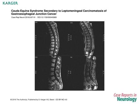 Case Rep Neurol 2016;8: DOI: /