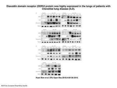 Discoidin domain receptor (DDR)2 protein was highly expressed in the lungs of patients with interstitial lung disease (ILD). Discoidin domain receptor.