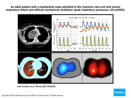 An adult patient with a mediastinal mass admitted to the intensive care unit with severe respiratory failure and difficult mechanical ventilation (peak.