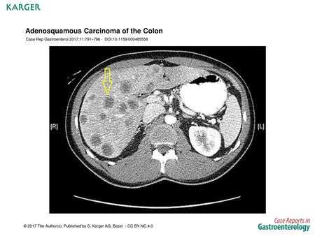 Adenosquamous Carcinoma of the Colon