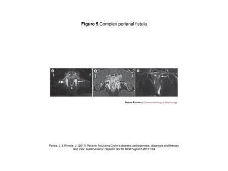 Figure 5 Complex perianal fistula