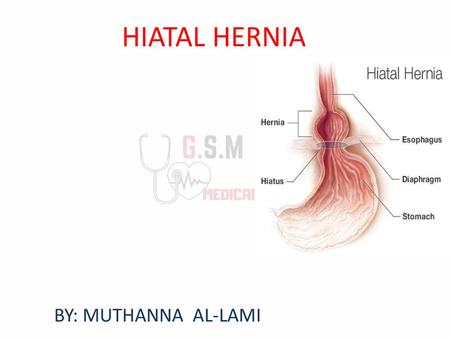 HIATAL HERNIA BY: MUTHANNA AL-LAMI.