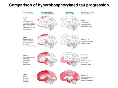 Comparison of hyperphosphorylated tau progression