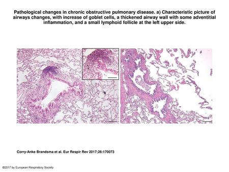 Pathological changes in chronic obstructive pulmonary disease