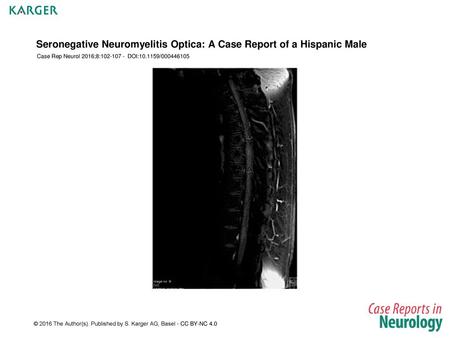 Seronegative Neuromyelitis Optica: A Case Report of a Hispanic Male