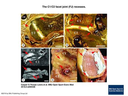 The C1/C2 facet joint (FJ) recesses.