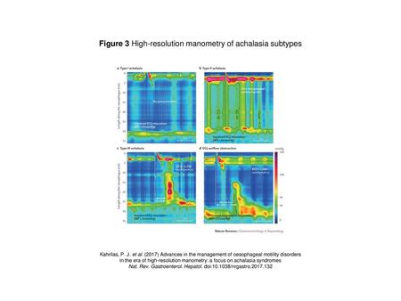 Figure 3 High-resolution manometry of achalasia subtypes