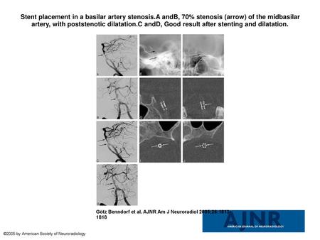 Stent placement in a basilar artery stenosis