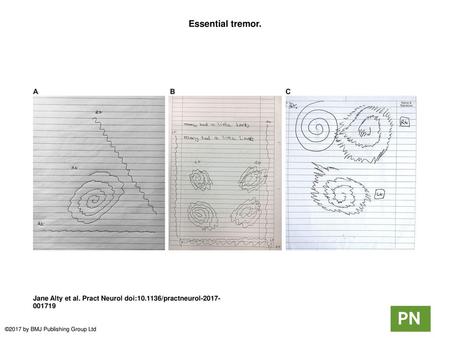 Essential tremor. Essential tremor. (A) The Archimedes spiral drawing shows a unidirectional tremor axis in the 8–2 o’clock direction, suggesting essential.