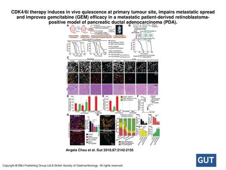 CDK4/6i therapy induces in vivo quiescence at primary tumour site, impairs metastatic spread and improves gemcitabine (GEM) efficacy in a metastatic patient-derived.