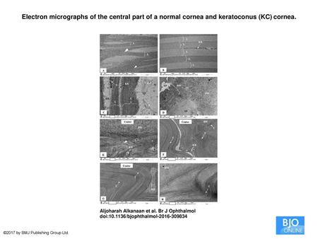 Electron micrographs of the central part of a normal cornea and keratoconus (KC) cornea. Electron micrographs of the central part of a normal cornea and.