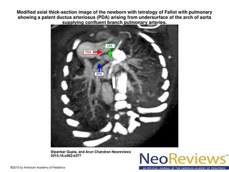 Modified axial thick-section image of the newborn with tetralogy of Fallot with pulmonary showing a patent ductus arteriosus (PDA) arising from undersurface.