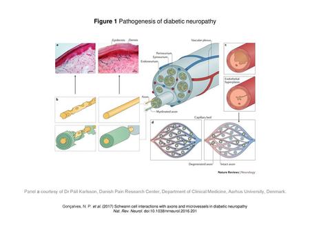 Figure 1 Pathogenesis of diabetic neuropathy