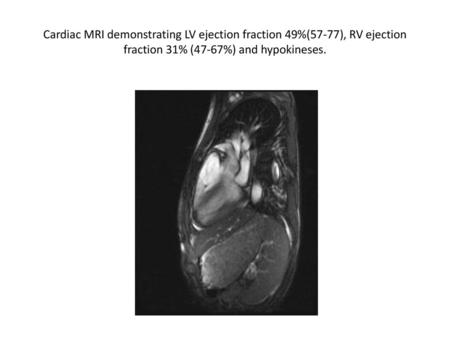 Cardiac MRI demonstrating LV ejection fraction 49%(57-77), RV ejection fraction 31% (47-67%) and hypokineses.