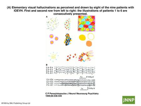 (A) Elementary visual hallucinations as perceived and drawn by eight of the nine patients with IOEVH. First and second row from left to right: the illustrations.