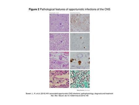 Figure 2 Pathological features of opportunistic infections of the CNS