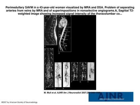 Perimedullary SAVM in a 43-year-old woman visualized by MRA and DSA