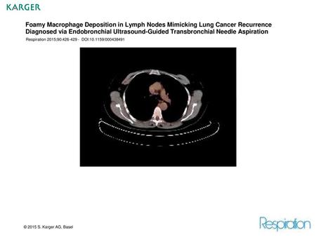 Foamy Macrophage Deposition in Lymph Nodes Mimicking Lung Cancer Recurrence Diagnosed via Endobronchial Ultrasound-Guided Transbronchial Needle Aspiration.