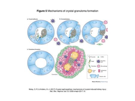 Figure 5 Mechanisms of crystal granuloma formation