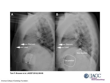 Tom F. Brouwer et al. JACEP 2016;2:89-96