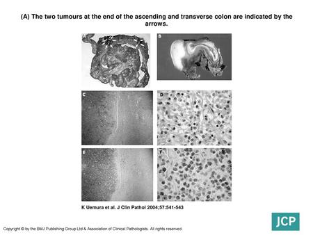 (A) The two tumours at the end of the ascending and transverse colon are indicated by the arrows. (A) The two tumours at the end of the ascending and transverse.