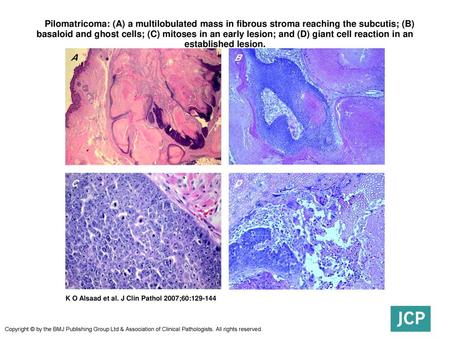  Pilomatricoma: (A) a multilobulated mass in fibrous stroma reaching the subcutis; (B) basaloid and ghost cells; (C) mitoses in an early lesion; and (D)