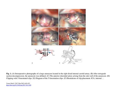 Fig. 1. (A) Intraoperative photographs of a large aneurysm located in the right distal internal carotid artery. (B) After retrograde suction decompression,