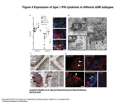 Figure 4 Expression of type 1 IFN cytokines in different aDM subtypes