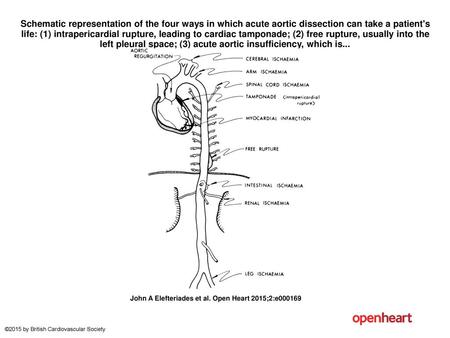 Schematic representation of the four ways in which acute aortic dissection can take a patient's life: (1) intrapericardial rupture, leading to cardiac.