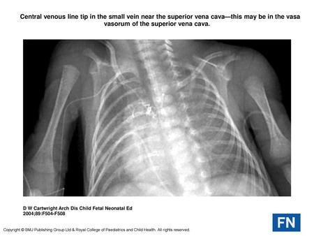  Central venous line tip in the small vein near the superior vena cava—this may be in the vasa vasorum of the superior vena cava.  Central venous line.