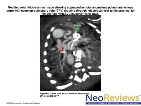 Modified axial thick-section image showing supracardiac total anomalous pulmonary venous return with common pulmonary vein (CPV) draining through left.