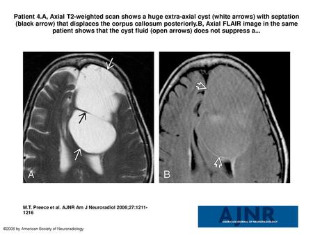 Patient 4.A, Axial T2-weighted scan shows a huge extra-axial cyst (white arrows) with septation (black arrow) that displaces the corpus callosum posteriorly.B,