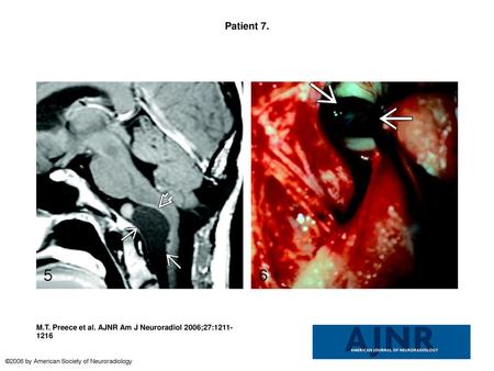 Patient 7. Patient 7. Sagittal postcontrast T1-weighted scan showing a large, well-delineated extra-axial mass (arrows) elevating and displacing the pons.