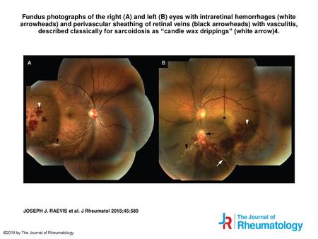 Fundus photographs of the right (A) and left (B) eyes with intraretinal hemorrhages (white arrowheads) and perivascular sheathing of retinal veins (black.