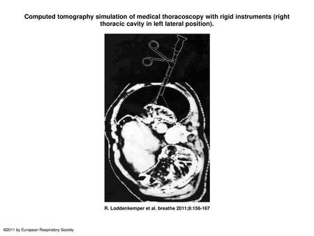 Computed tomography simulation of medical thoracoscopy with rigid instruments (right thoracic cavity in left lateral position). Computed tomography simulation.