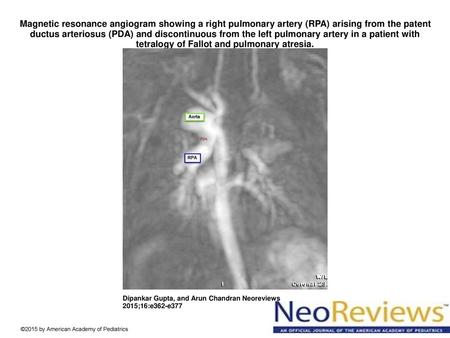 Magnetic resonance angiogram showing a right pulmonary artery (RPA) arising from the patent ductus arteriosus (PDA) and discontinuous from the left pulmonary.