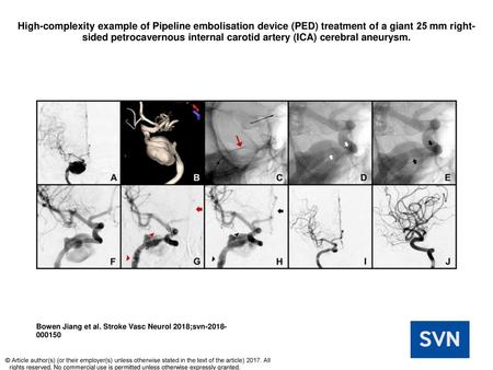 High-complexity example of Pipeline embolisation device (PED) treatment of a giant 25 mm right-sided petrocavernous internal carotid artery (ICA) cerebral.