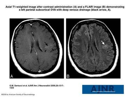 Axial T1-weighted image after contrast administration (A) and a FLAIR image (B) demonstrating a left parietal subcortical DVA with deep venous drainage.