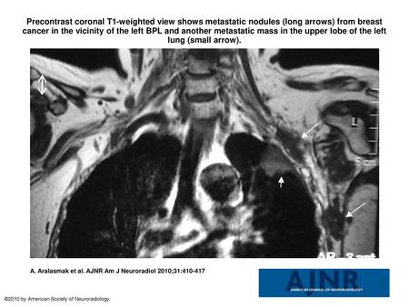 Precontrast coronal T1-weighted view shows metastatic nodules (long arrows) from breast cancer in the vicinity of the left BPL and another metastatic mass.