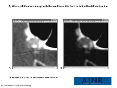 A, Where calcifications merge with the skull base, it is hard to define the delineation line. A, Where calcifications merge with the skull base, it is.