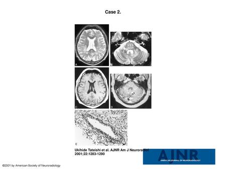 Case 2. Case 2. A and B, T2-weighted images (fast spin-echo sequence with parameters of 4500/96 [TR/TE]) show diffuse hyperintense lesions in the white.