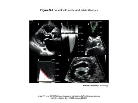 Figure 3 A patient with aortic and mitral stenosis