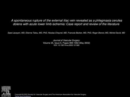 A spontaneous rupture of the external iliac vein revealed as a phlegmasia cerulea dolens with acute lower limb ischemia: Case report and review of the.