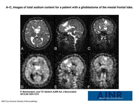 A–C, Images of total sodium content for a patient with a glioblastoma of the mesial frontal lobe. A–C, Images of total sodium content for a patient with.